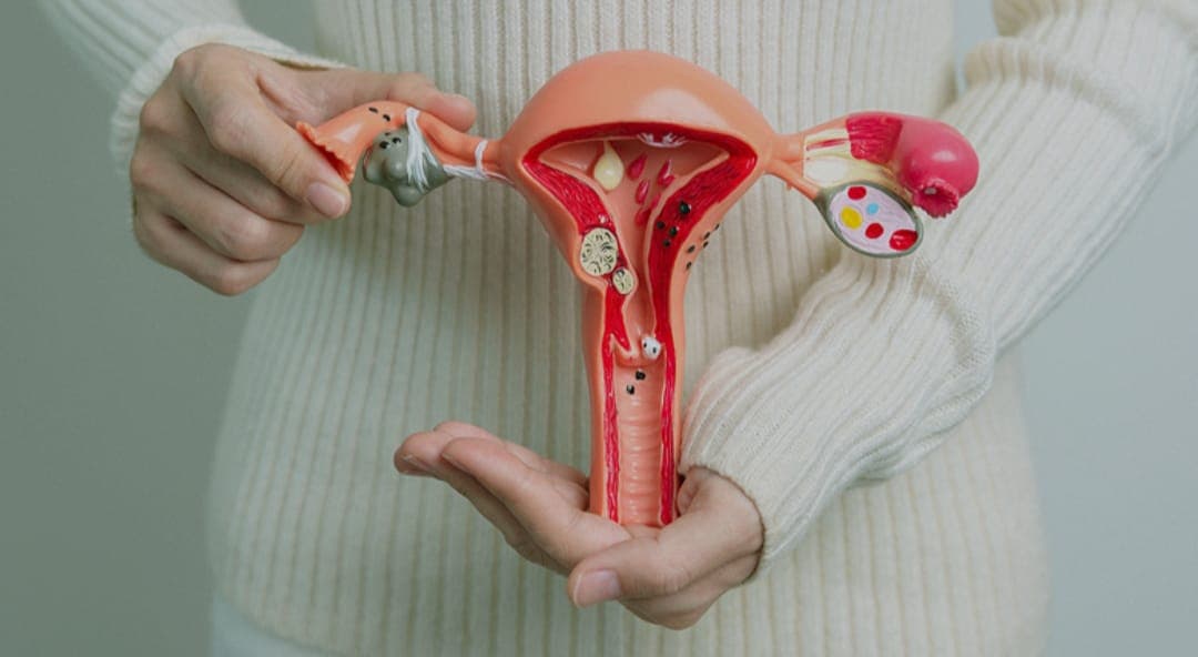 SOP - Síndrome dos Ovários Policísticos